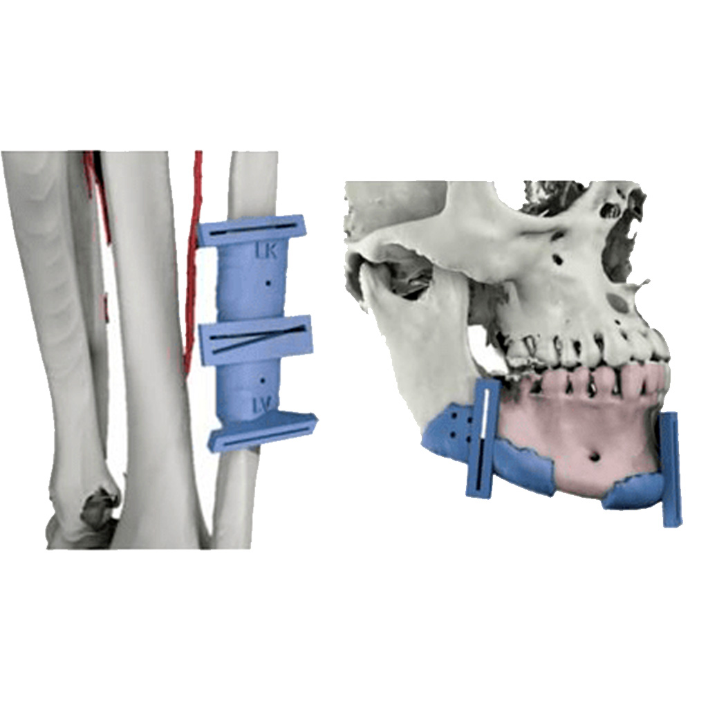 Biomodelos y Guías Quirúrgicas