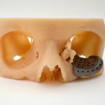 Implantes a medida Implantes a medida